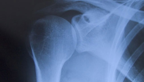 Napredak u istraživanju osteoporoze
