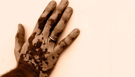 Svjetski dan oboljelih od vitiliga