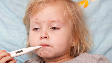 Pada broj djece cijepljene protiv ospica