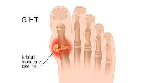 kako liječiti bol u zglobu na stopalu