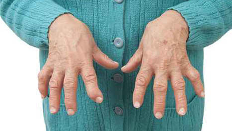artritis zglobova boli