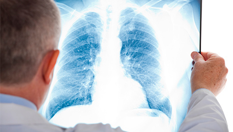 Umjetna inteligencija u otkrivanju raka pluća