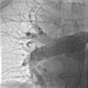 Angiografija desne plućne arterije nakon aspiracije ugruška.