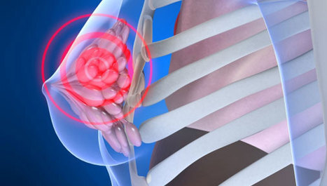 Rak dojke djeluje protiv imunološkog sustava
