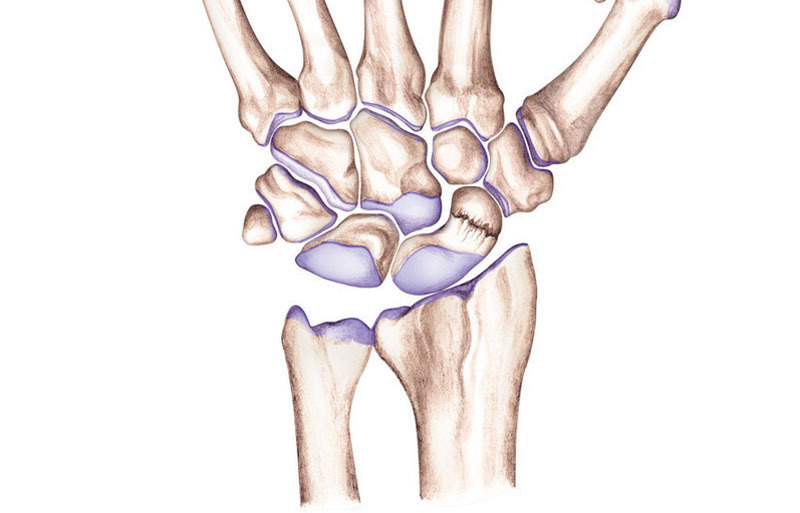 Dislocarea încheieturii mâinii: simptome și tratament - Boli Și Condiții 