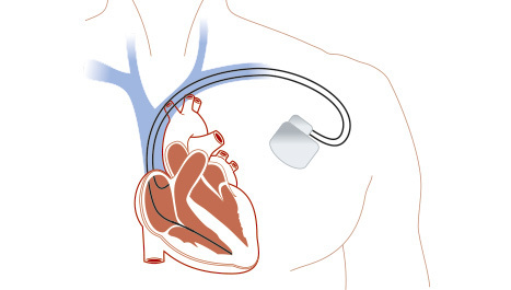 Pacemaker - elektrostimulacija srca