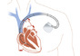 Pacemaker - elektrostimulacija srca