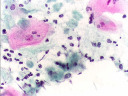Trichomoniasis (trihomonasni vaginitis)