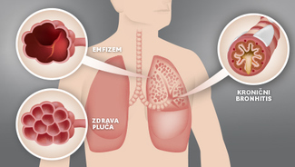KOPB - Kronična opstruktivna plućna bolest