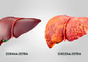 Masna jetra - što je i kako se liječi?