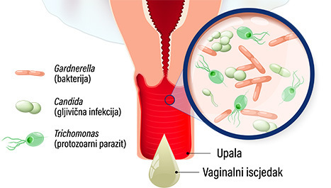 Vrste vaginalnih infekcija: bakterijska vaginoza, kandidijaza i trihomonijaza
