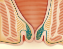 Hemoroidi trećeg stupnja su stalno vani, ali se mogu prstima vratiti nazad u analni kanal. Tegobe su povremeno krvarenje nakon stolice, svrbež i pečenje, osjećaj punoće u anusu, a također se javljaju se "vanjski" hemoroidi u obliku kožnih privjesaka. Ponekad se primjećuje smeđi ili krvavi iscjedak na donjem rublju.