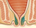 Stalno prolabirani hemoroidi koji se ne mogu niti prstima vratiti u analni kanal predstavljaju hemoroide četvrtog stupnja. Tegobe su stalna nelagoda i bol, česta krvarenja nevezana za stolicu, smeđi ili krvavi iscjedak na donjem rublju, što je sve obično praćeno velikim "vanjskim" hemoroidima.