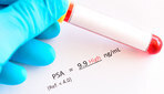 Amoxicillin prosztatagyulladás-kezeléssel és hatással van a potenciálra