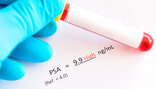 PSA - prostata specifični antigen 