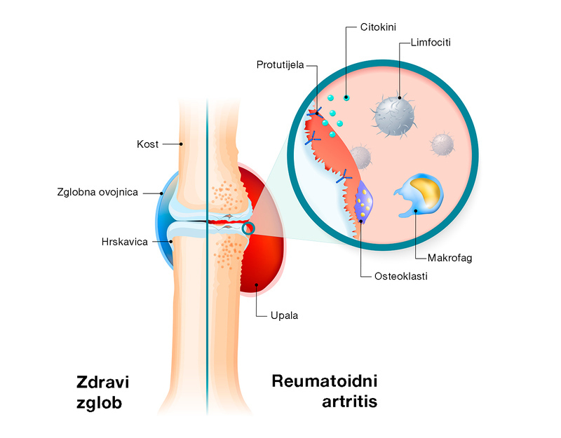 liječenje artritisa rebro