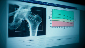 Znamo li sve o osteoporozi?