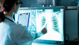 Nove mogućnosti liječenja plućne embolije